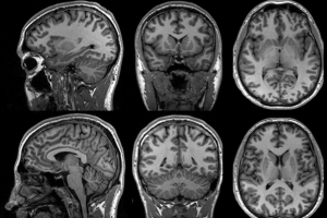 medical imaging of a skull and brain