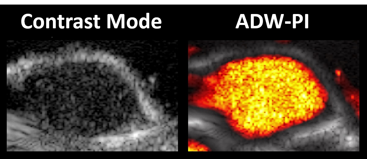 Figure 1. Ultrasound image of a mouse hindlimb tumor with adherent microbubbles on the tumor interior.