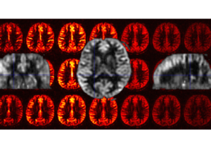 Brain MRI images